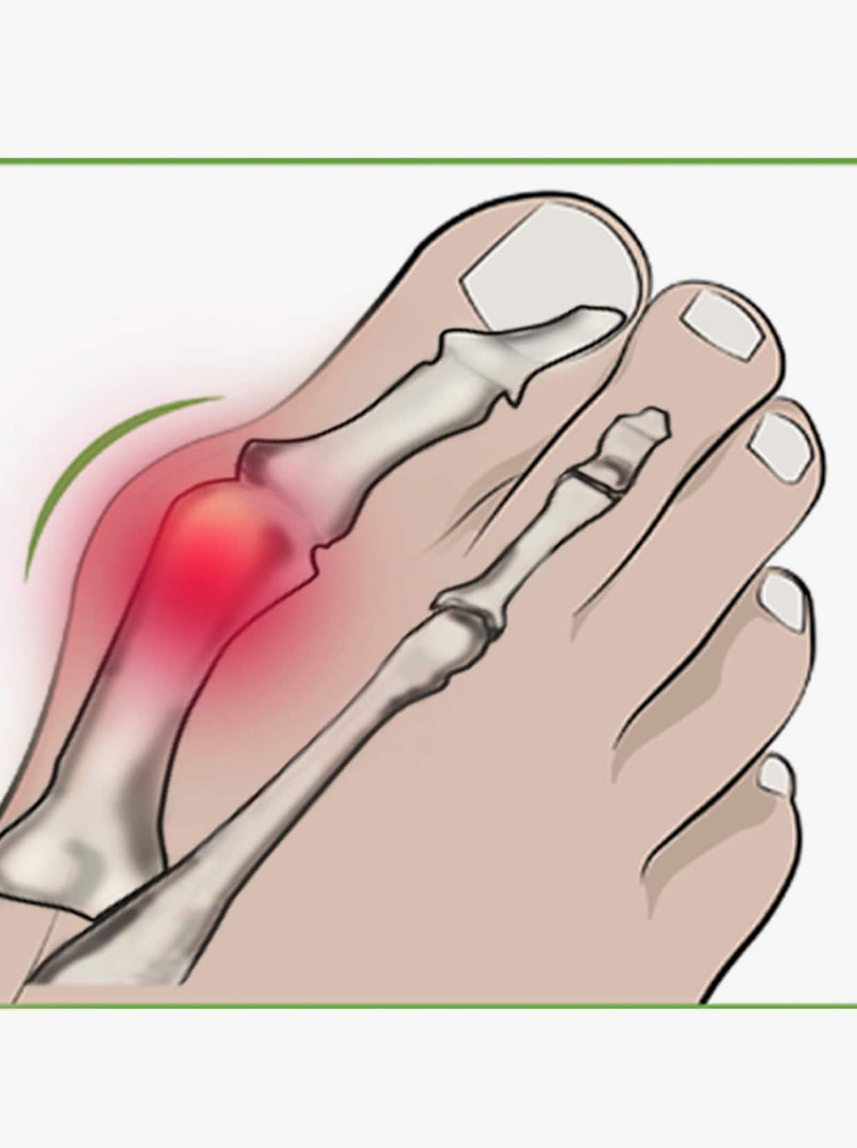 Ochrana pri hallux valgus - béžová