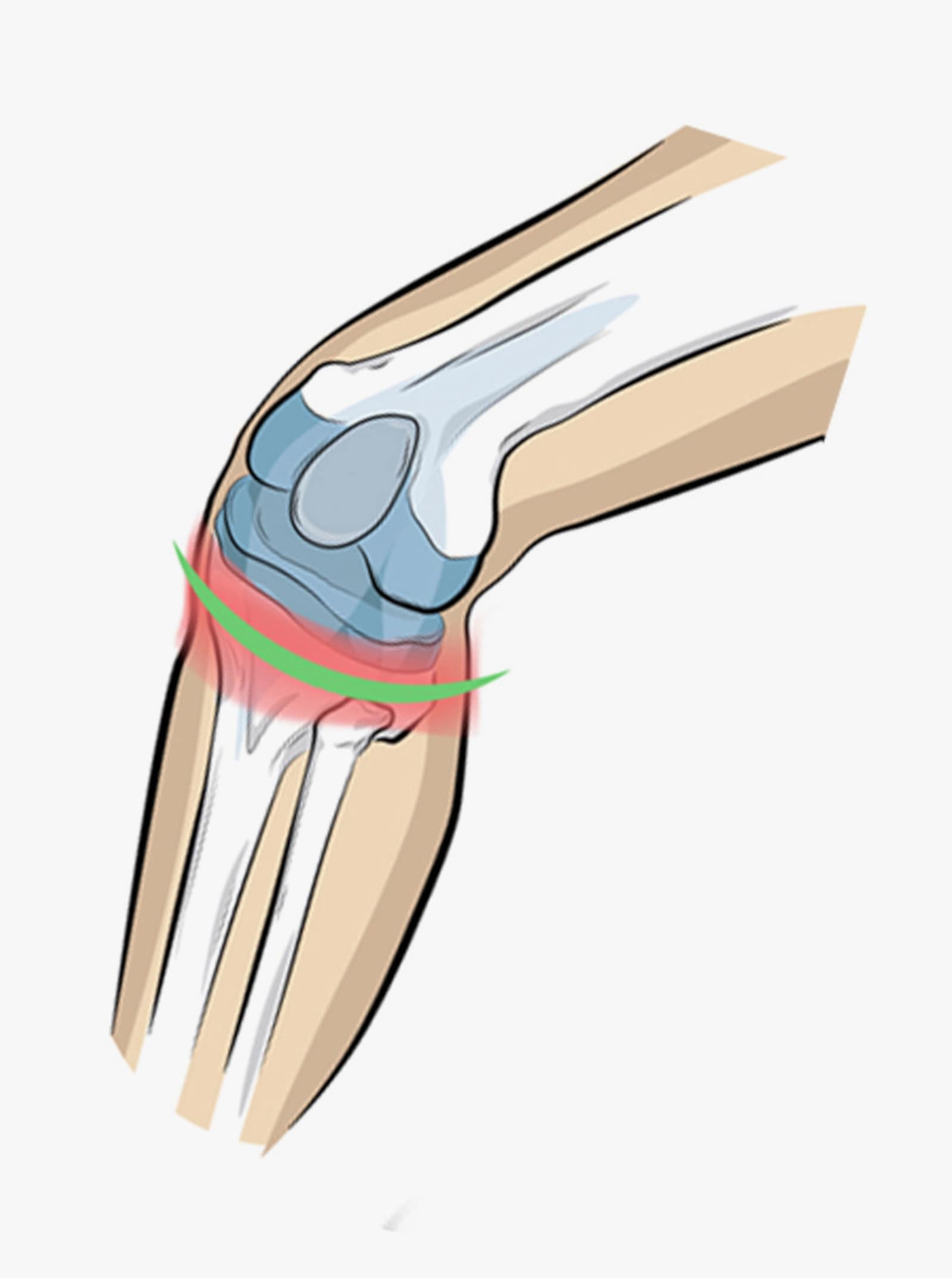 Kniebandage - schwarz